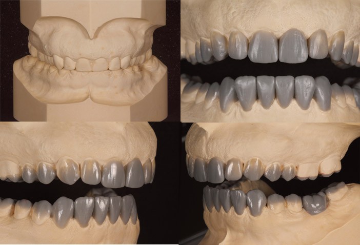 Wax-up sur modèles en plâtre, vue de face et de profil
