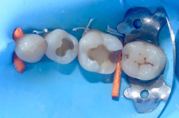 Dents sous digue après la dépose des amalgames, cavités nettoyées