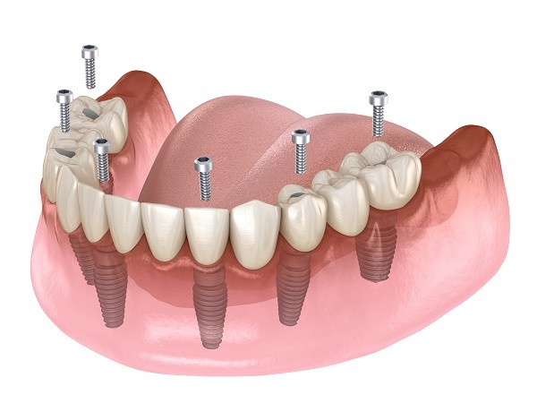 Illustration d’un bridge complet du bas vissé sur des implants