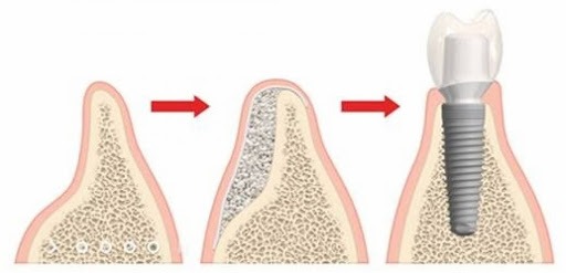 Trois schémas : un os trop fin, l’os reconstruit par un substitut osseux, puis l’implant posé dans l’os reconstruit