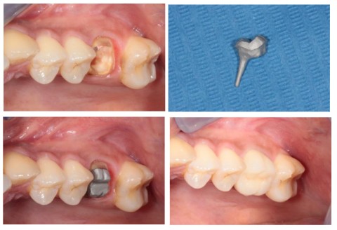 Dent délabrée, inlay-core fabriqué au laboratoire, inlay-core scellé, puis couronne en place