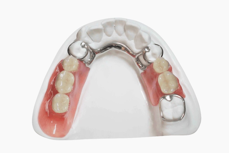 Stellite du bas posé sur un modèle : châssis métallique, dents de remplacement sur fausse gencive rose et crochets autour des dents restantes