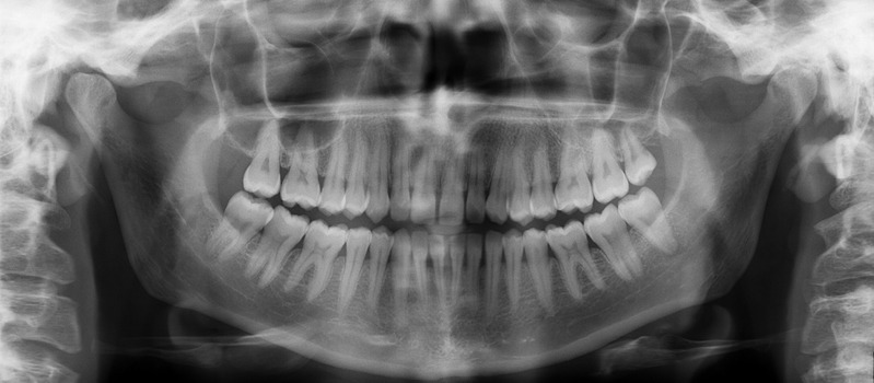 Exemple de radiographie panoramique : les deux mâchoires, toutes les dents et leurs racines, l’os et les articulations sur une seule image.