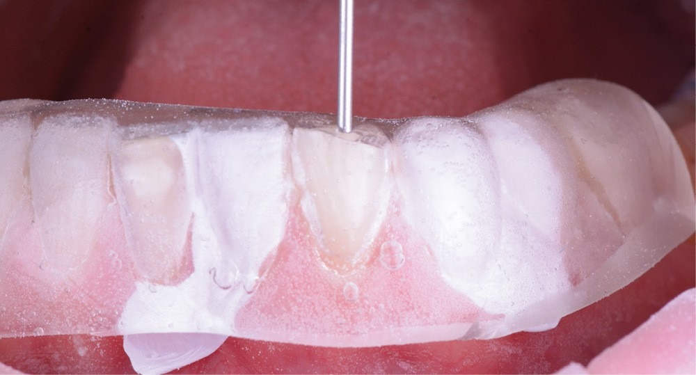 La clé transparente posée sur les dents : la résine composite est injectée dent par dent par un petit orifice, pour reproduire fidèlement la forme du projet.