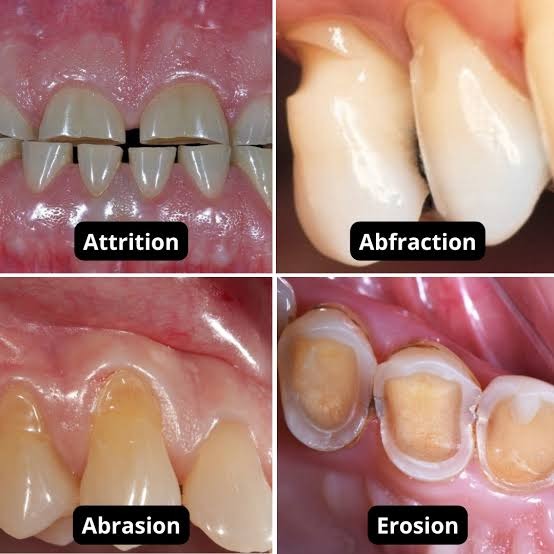 Les quatre types d’usure : attrition (bruxisme), abfraction, abrasion et érosion.